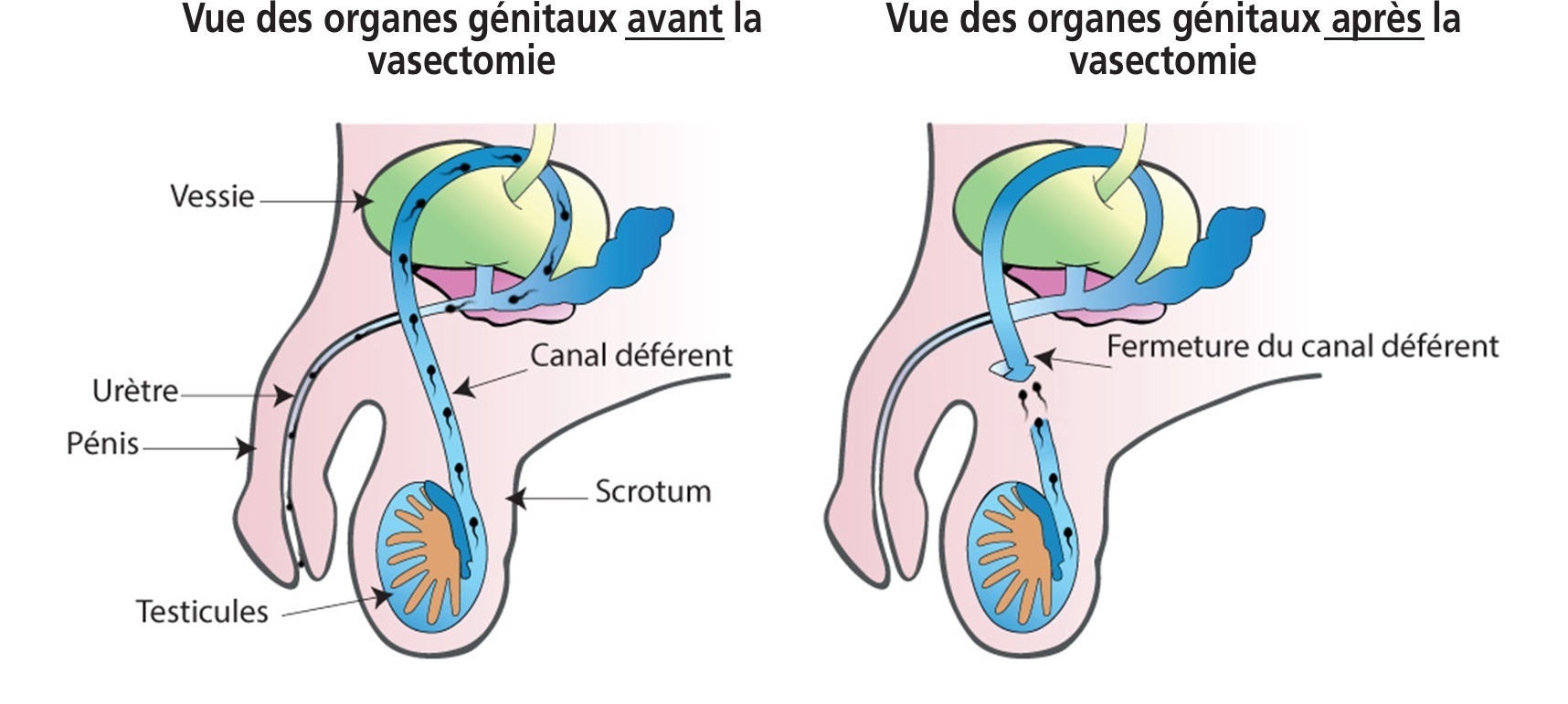 avant-apres-vasectomie-1