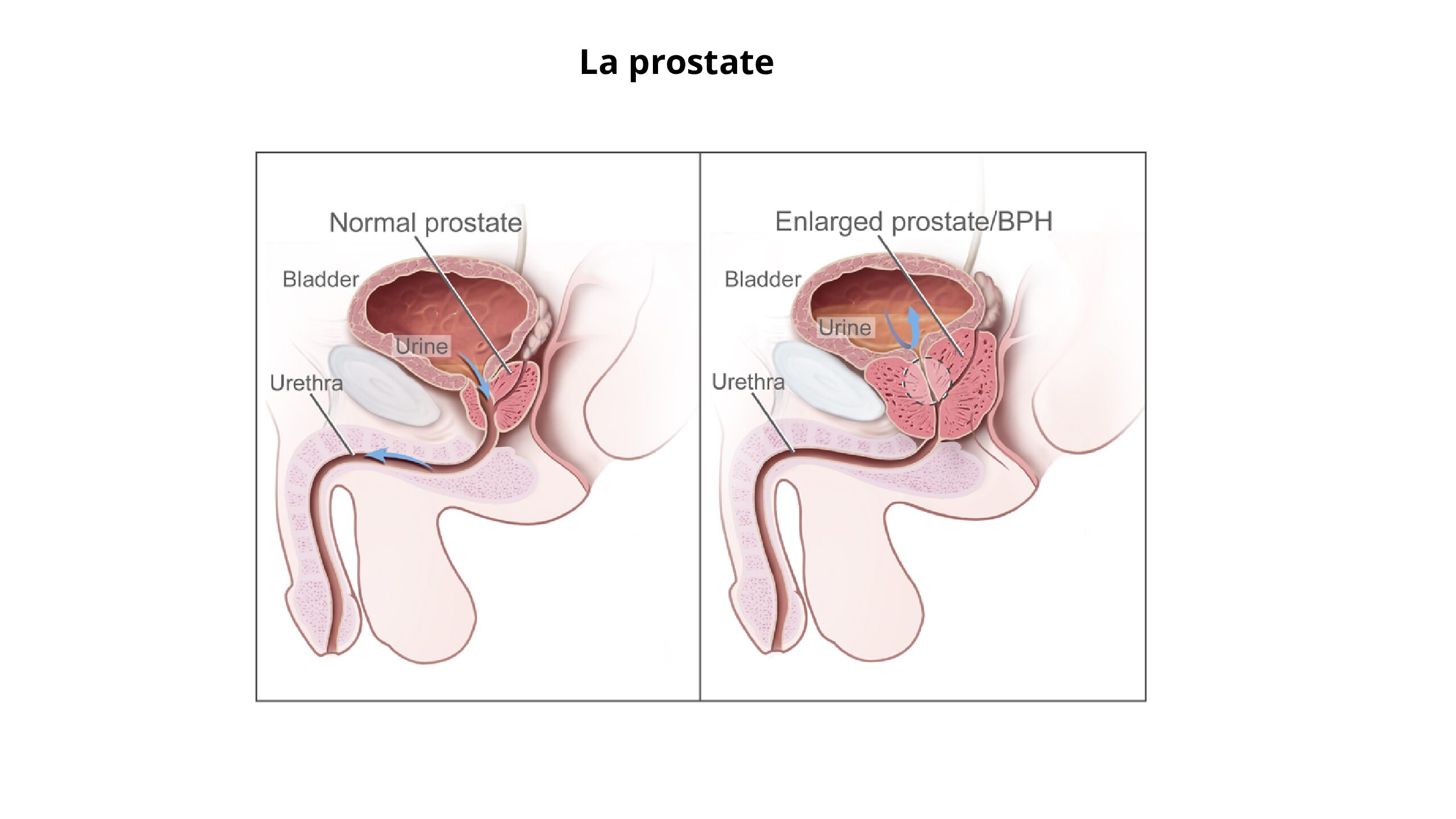 la prostate